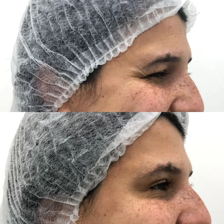 botox paciente 1 (2)