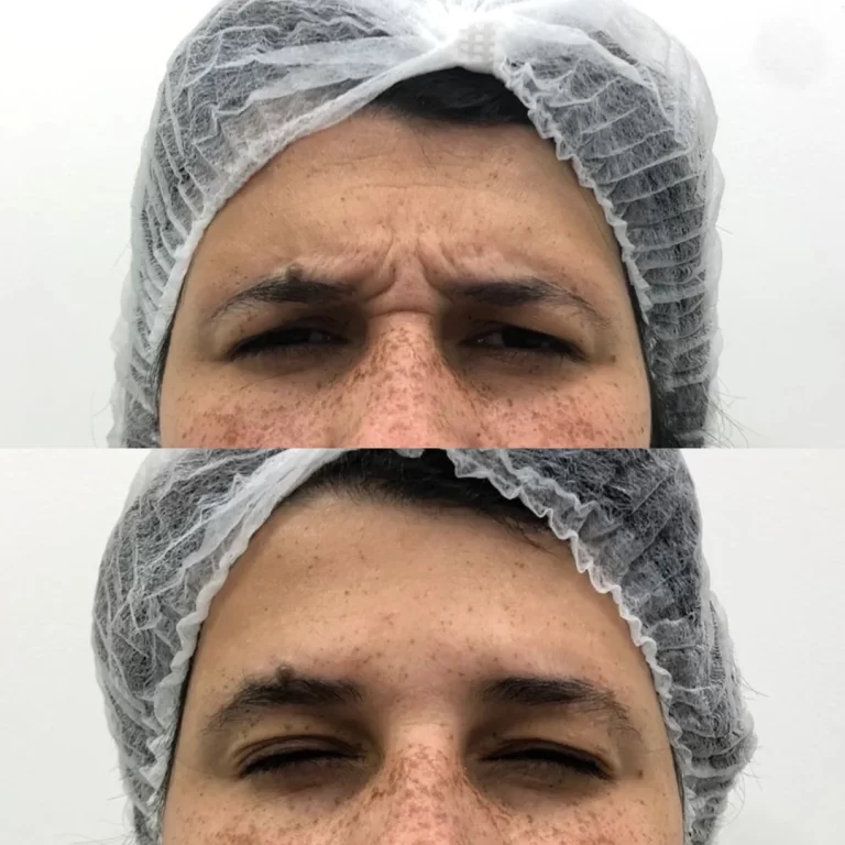 botox paciente 1 (3)