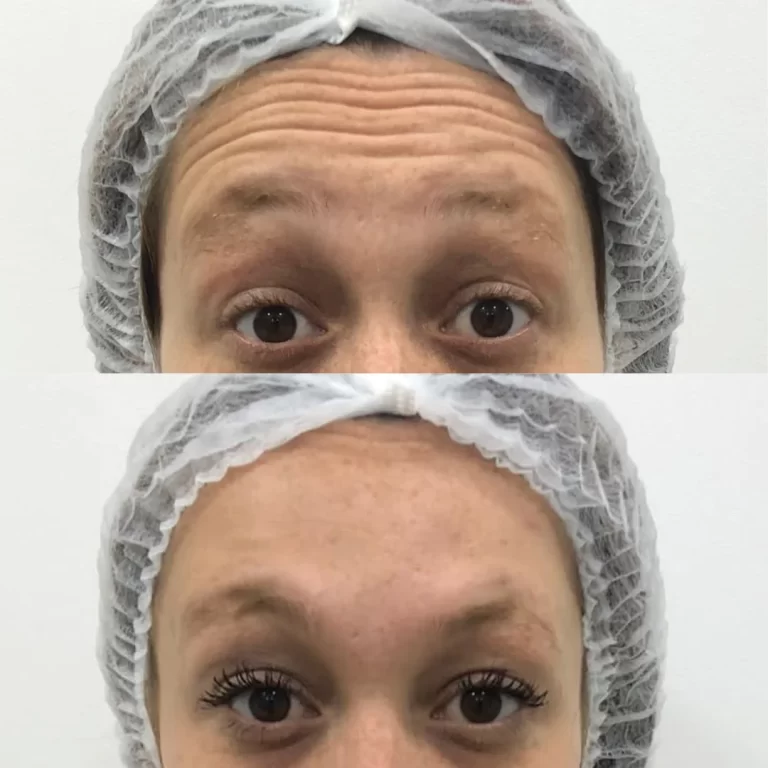 botox paciente 2 (2)