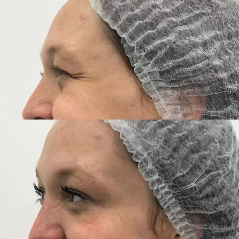 botox paciente 2 (3)