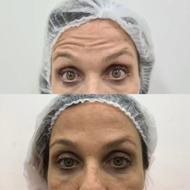 botox paciente 3 (2)