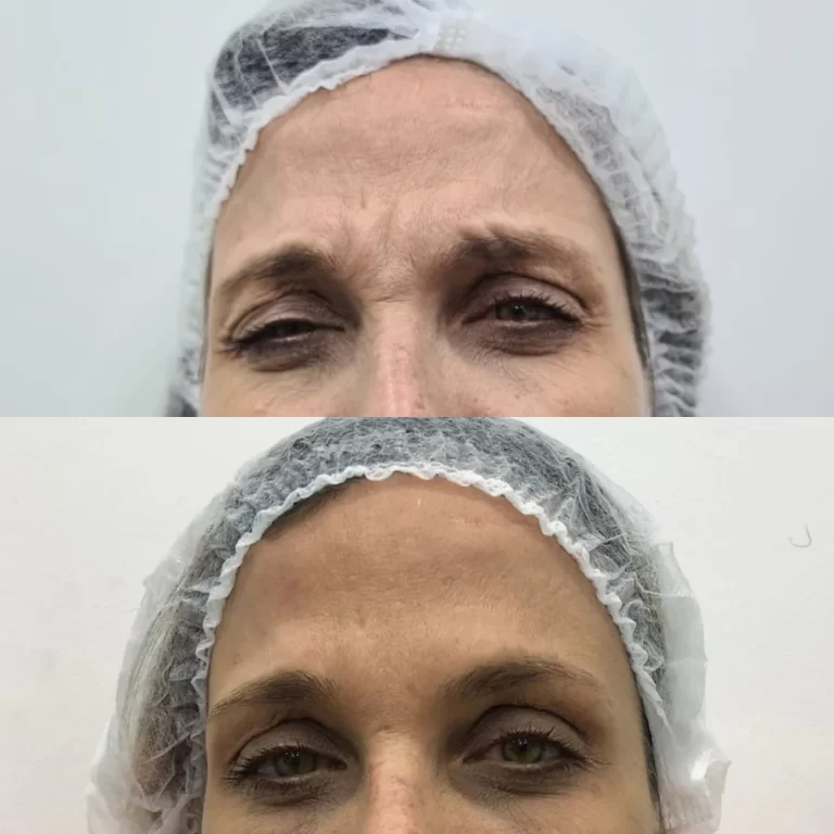 botox paciente 3 (3)