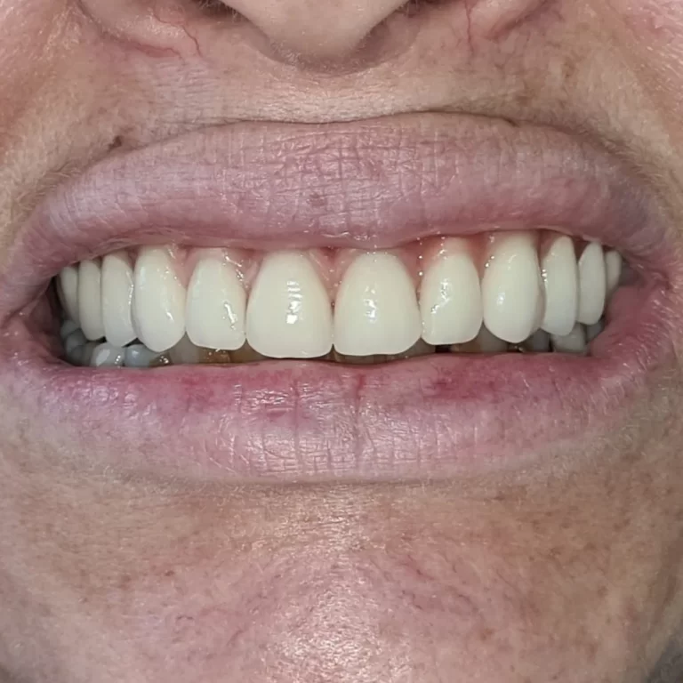 protocolo superior 1.1